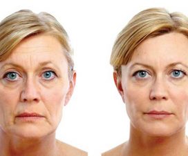 ¿Qué es el lifting facial con láser?