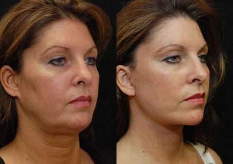 mini lifting facial antes y después total varsta repara ridurile reduce royal b b crema